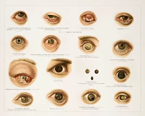 Images Dated 26th June 2015: Human eye diseases lithograph 1896