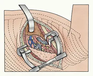 Open Prints: Illustration of abdominal incision between ribs kept open by spreaders exposing human lung and blood vessels
