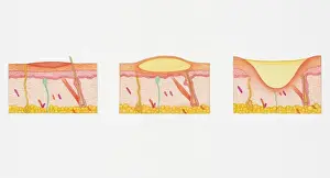 Physical Injury Prints: Illustration of blistering second degree burn in epidermis and dermis in three cross sections of human skin