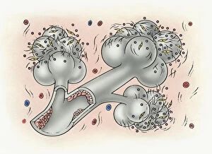 Illustration of bronchus and alveolus covered in inorganic particles, fibroblasts