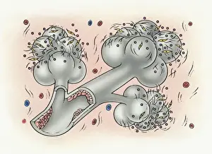 Bronchus Prints: Illustration of bronchus and alveolus covered in inorganic particles