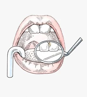 Illustration of dental examination using mirror and suction tube