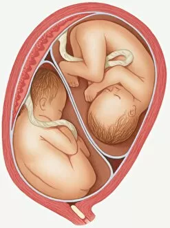 Twin Gallery: Illustration of dizygotic twins in uterus, and mucus plug in cervix