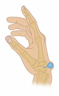 Images Dated 9th April 2016: Illustration of dorsal wrist Ganglion cyst