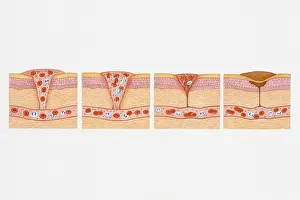 Blood Vessel Prints: Illustration of formation of blood clot in series of four cross section illustrations showing blood oozing from blood