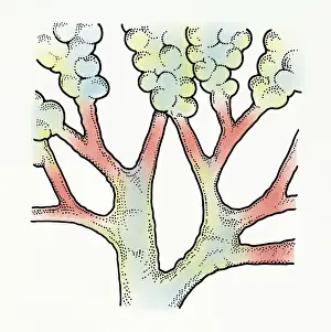 Bronchi Prints: Illustration of inflamed bronchi causing breathing difficulties in childhood