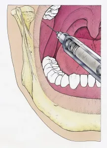 Human Teeth Prints: Illustration of injecting open human mouth using syringe seen in cross section showing jaw bone
