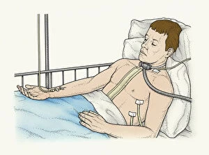 Illustration of male patient lying in bed connected to IV drip, ventilator attached to trachea