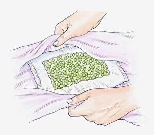 Illustration of a pack of frozen peas being wrapped in a towel to use as a cold compress