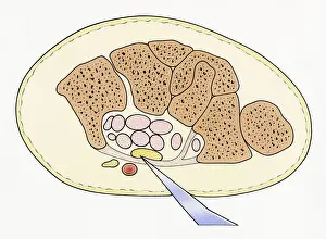 Wounded Prints: Illustration showing cross section of severed median nerve in wrist caused by sharp piece of glass penetrating skin