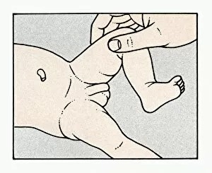 Images Dated 25th November 2008: Illustration showing physical examination of babys testis and penis immediately after birth