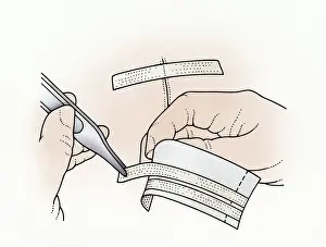First Aid Prints: Illustration showing removal of butterfly stitches from adhesive paper using tweezers to apply to wound