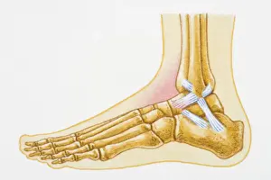 Physical Injury Prints: Illustration showing swollen talocrural joint caused by sprain to anterior talofibular ligament