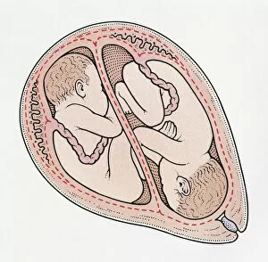 Twin Gallery: Illustration of twin foetuses in cross section of human uterus, one in breech position