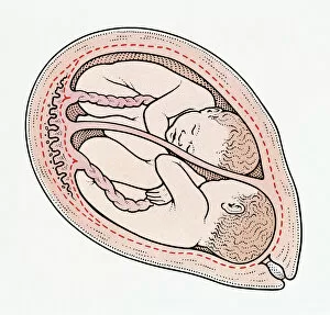 Twin Gallery: Illuystration of twin foetuses in normal position in cross section of human uterus