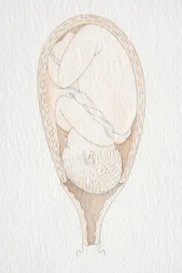 Delivery Prints: Inverted foetus inside swollen uterus with head pushing through the dilated cervix opening