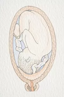 Inverted foetus inside swollen uterus with placenta covering cervix opening
