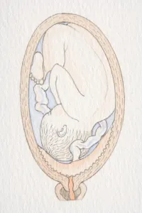 Delivery Prints: Inverted foetus inside swollen uterus with placenta covering cervix opening
