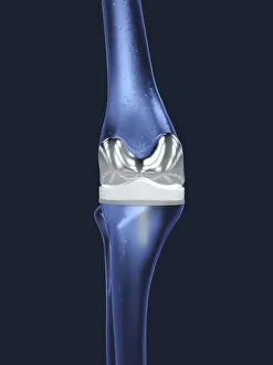 Knee replacement, illustration