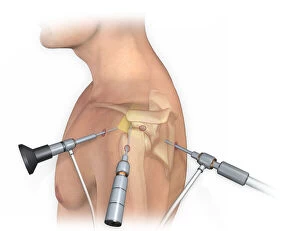 Lateral view of arthroscopic surgical repair on the shoulder joint