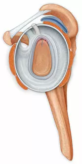 Lateral view of the shoulder joint showing the repair to the labrum