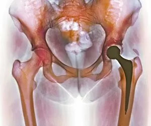 Loosened hip replacement, X-ray