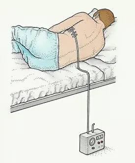 Prints of Bed, Caucasian Appearance, Chest Drain, Healthcare and Medicine, Hospital, Lying On Side, Medical Technological Equipment, One Person, One Young Man Only, Pen and Ink, Pneumothorax, Rear View Unlock the world's wonders with Dorling Kindersley's captivating illustrations – where knowledge meets artistry in every stroke: A man on a bed with a chest drain in his side recovering from pneumothorax (collapsed lung)