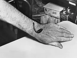 Arms Prints: Man Receiving Help from Leech