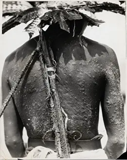 Scar Prints: Man From San Blas W/Scarring On Back