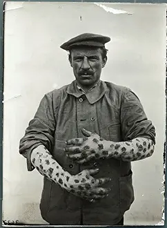 Suffering Prints: Man with Sores on Arms and Hands
