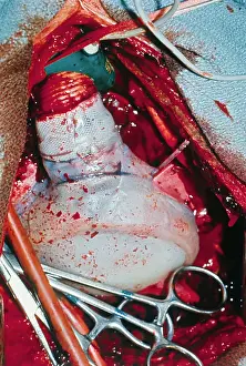 Mechanical Heart Being Transplanted
