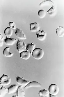 Disease Prints: Microscopic Picture Of Sickle Cells