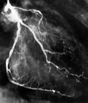 Images Dated 5th February 2009: Narrowed coronary arteries (B&W)