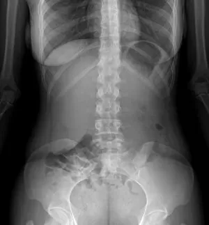 Young Women Gallery: Normal abdomen, X-ray