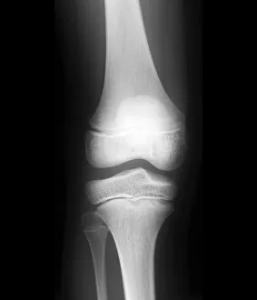 Colour Collection: Normal childs knee, X-ray