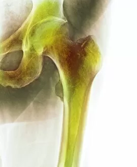 Normal hip, X-ray