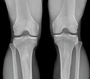 Science And Technology Gallery: Normal knees, X-ray