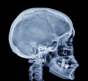 Science And Technology Gallery: Normal skull, X-ray