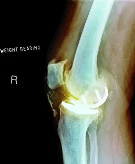 Radiography Collection: Osteoarthritis of the knee, X-ray