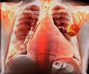 Science Inspired Art Gallery: Pacemaker in heart disease, X-ray