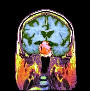 Science Inspired Art Gallery: Pituitary tumour, CT scan