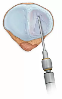 Posterior view patellar surface showing injured cartilage being cleaned up with a shaver