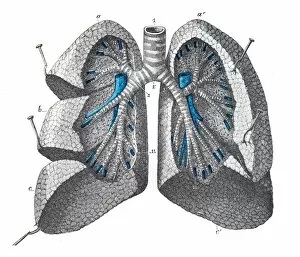 Images Dated 3rd June 2015: Pulmonary mass engraving 1899