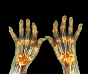Radiography Collection: Rheumatoid arthritis, X-ray