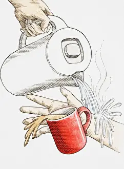 Splashing Prints: Scolding by accidentally pouring boiling hot water from modern kettle onto arm