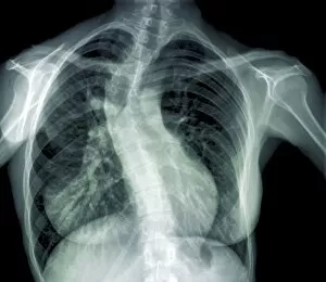 Close Up Gallery: Scoliosis of the spine, X-ray