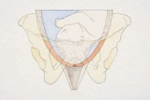 Delivery Prints: Section diagram of swollen uterus with foetus head pushing down on cervix opening