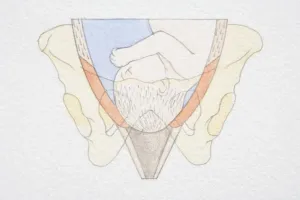 Delivery Prints: Section diagram of swollen uterus with foetus head pushing through the dilated cervix opening