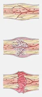 Recovery Prints: Sequence of illustrations showing complete bone fracture and healing process