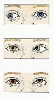Sequence of illustrations showing Strabismus, Amblyopia, and Duane syndrome in children